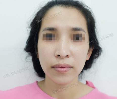 Nâng mũi cấu trúc sụn sườn + cắt xương + Độn cằm sửa lại