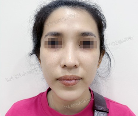 Nâng mũi cấu trúc sụn sườn + cắt xương + Độn cằm sửa lại