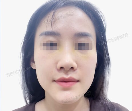 Nâng mũi lót sụn + cắt cánh + cà gồ