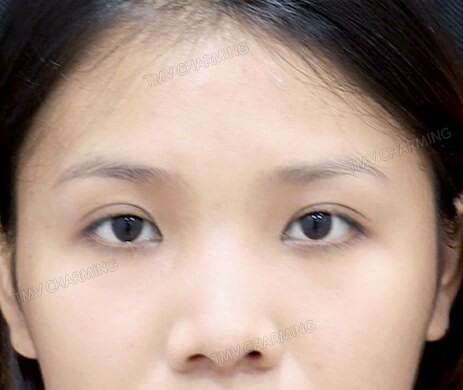 Mở góc mắt sau 1 tháng