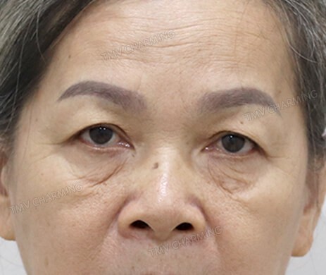 Treo cung mày – Cắt mí dưới sau 7 ngày