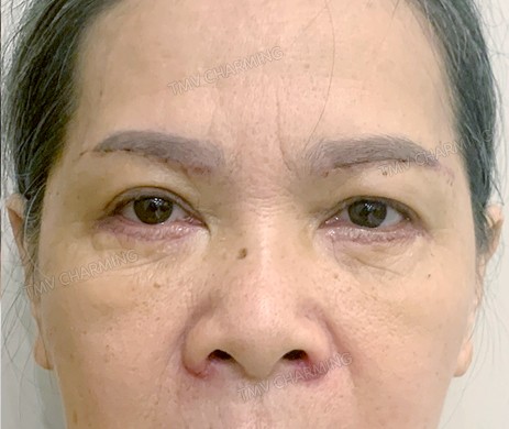 Treo cung mày – Cắt mí dưới sau 7 ngày