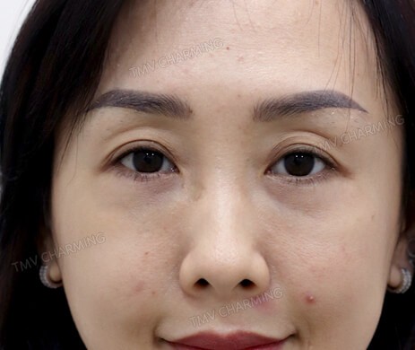 Cấy mỡ mí trên sau 1 tháng