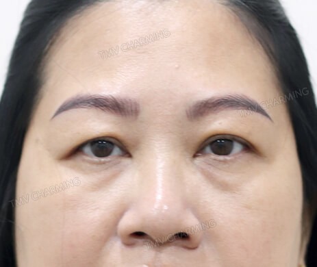 Cắt mí trên – mí dưới