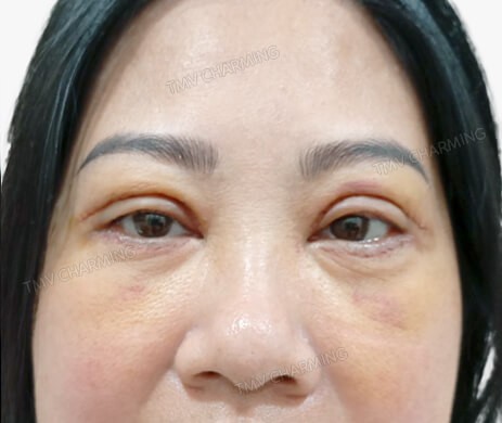 Cắt mí trên – mí dưới