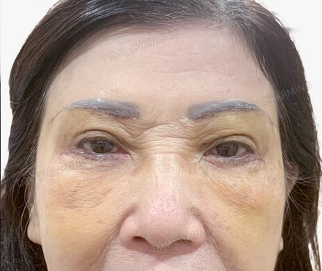 Treo cung mày – Cắt mí dưới – Cấy mỡ rãnh lệ sau 7 ngày