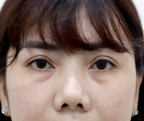 Cắt mí dưới – Cấy mỡ mí dưới sau 19 ngày