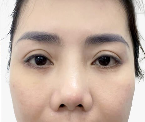 Cắt mí dưới – Cấy mỡ mí dưới sau 19 ngày