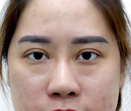 Cắt mí dưới – Cấy mỡ mí dưới sau 1 tháng