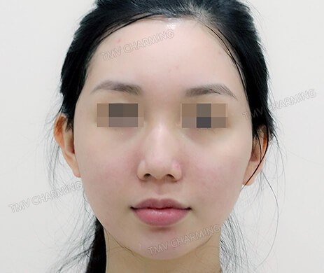 Độn cằm sau phẫu thuật 1 tháng