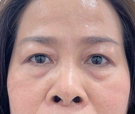 Cắt mí dưới sau 1 tháng