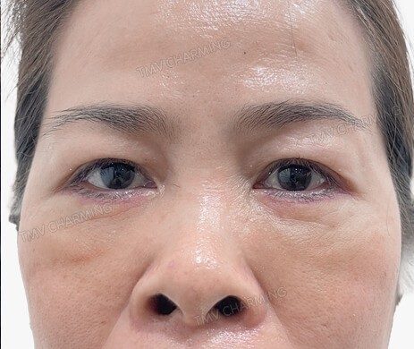 Cắt mí dưới sau 1 tháng