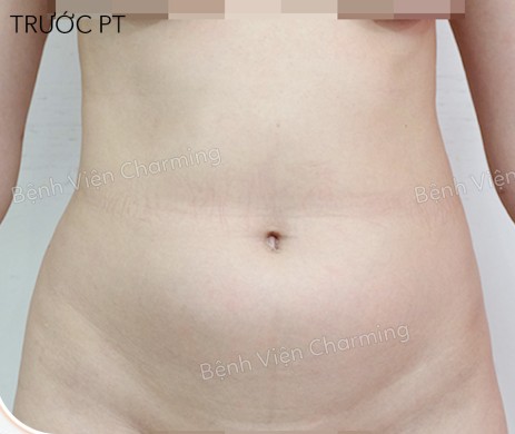 HÚT MỠ BUNG – 2 HÔNG SAU PT 3 THÁNG