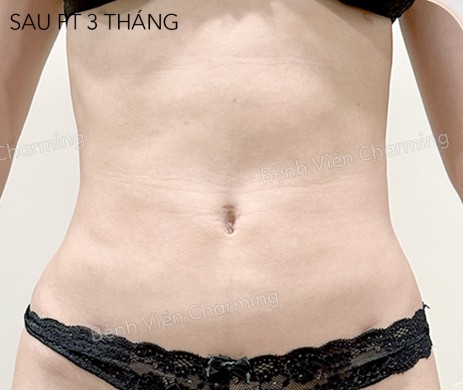 HÚT MỠ BUNG – 2 HÔNG SAU PT 3 THÁNG
