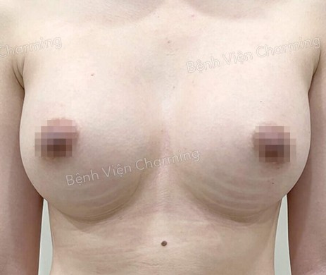 ĐẶT TÚI NGỰC SAU 5 THÁNG