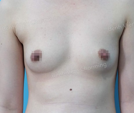 ĐẶT TÚI NGỰC SAU 5 THÁNG