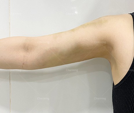 Hút mỡ tay + cắt da 10 ngày