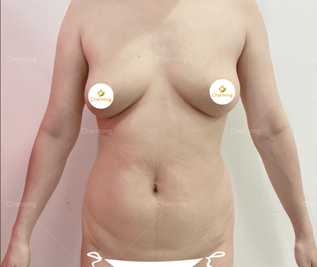 Hút mỡ bụng + lưng + Tay sau 1 tháng