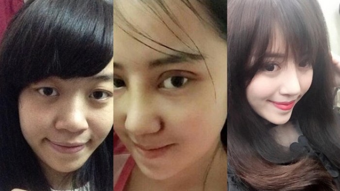 Bà mẹ 9x đẹp toàn diện sau phẫu thuật