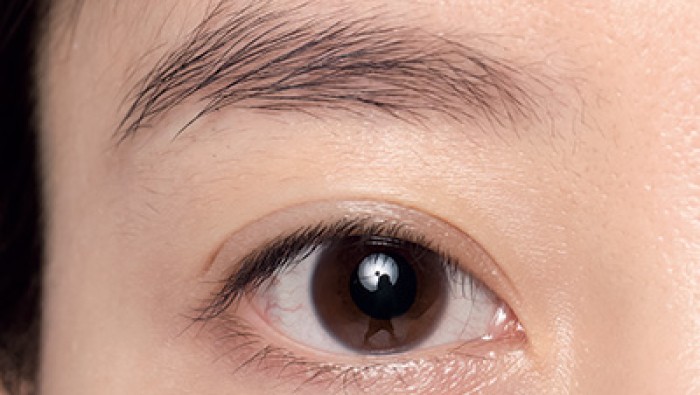 Cắt da mỡ thừa mí trên