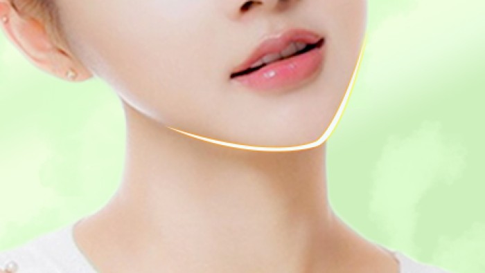 Phẫu thuật độn cằm V-line