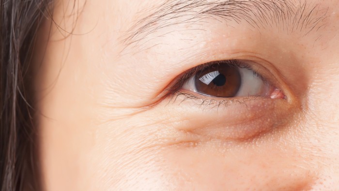 Phẫu Thuật Sụp Mi