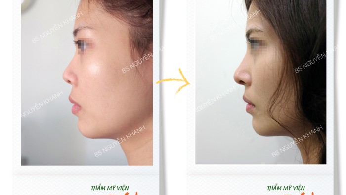 8 câu hỏi thường gặp khi nâng mũi