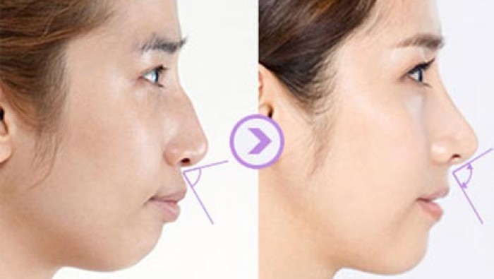 Xu hướng phẫu thuật thẫm mỹ được giới trẻ ưa chuộng