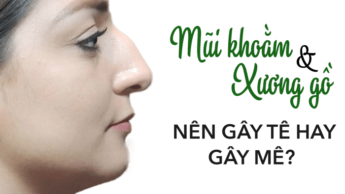 Mũi khoằm xương gồ nên gây tê hay mê