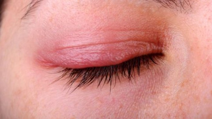 Cắt mí trên – Phương pháp trị viêm bờ mi tái đi tái lại nhiều lần