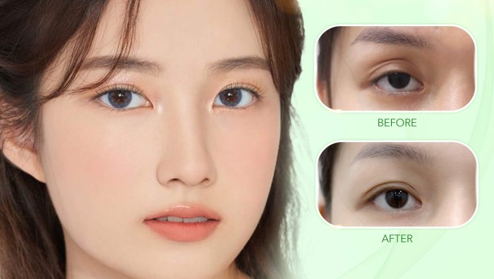 MẮT HỐC? ĐỪNG LO! CẤY MỠ LÀ XONG NGAY