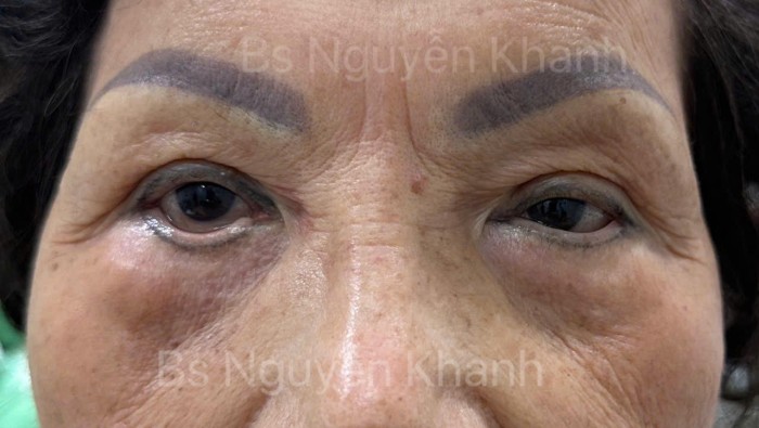 Mí dưới – chỉnh sửa lật mí dưới