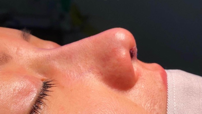 Nâng mũi – Cắt mí: “Mỗi 1 tác phẩm – Mỗi 1 tự hào”