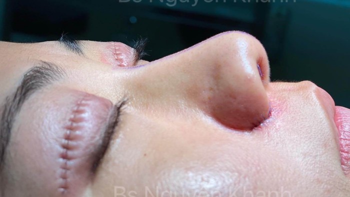 Có thể nâng mũi và cắt mắt cùng lúc được không?