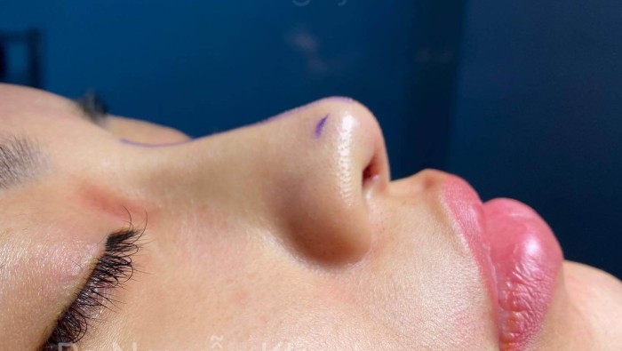 Tổng hợp các dáng mũi lót sụn sau phẫu thuật của ekip BS Nguyễn Khanh