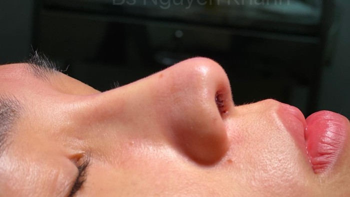 Nhìn ngắn 2 phương pháp mũi cấu trúc và lót sụn sau tết cùng ekip Bs Nguyễn Khanh