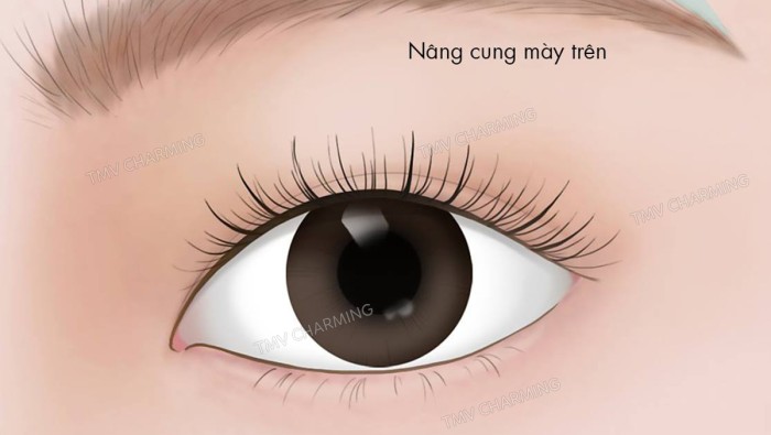 Phân biệt 2 phương pháp nâng cung mày: treo bờ trên và treo bờ dưới