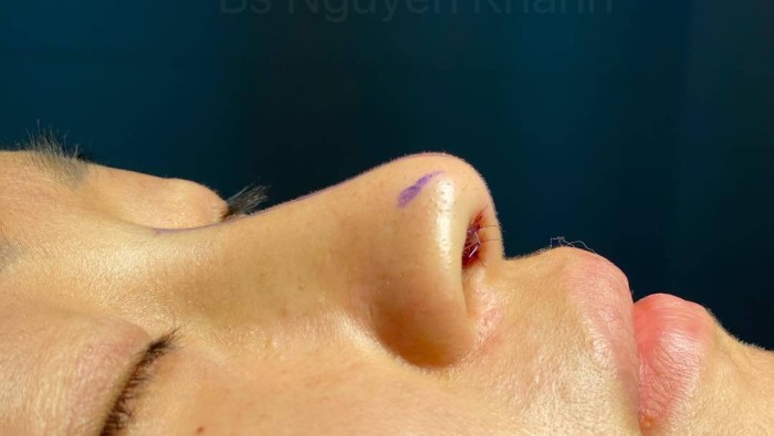 Phương pháp nâng mũi nào thích hợp cho dáng mũi cao nhưng chóp mũi lại thấp