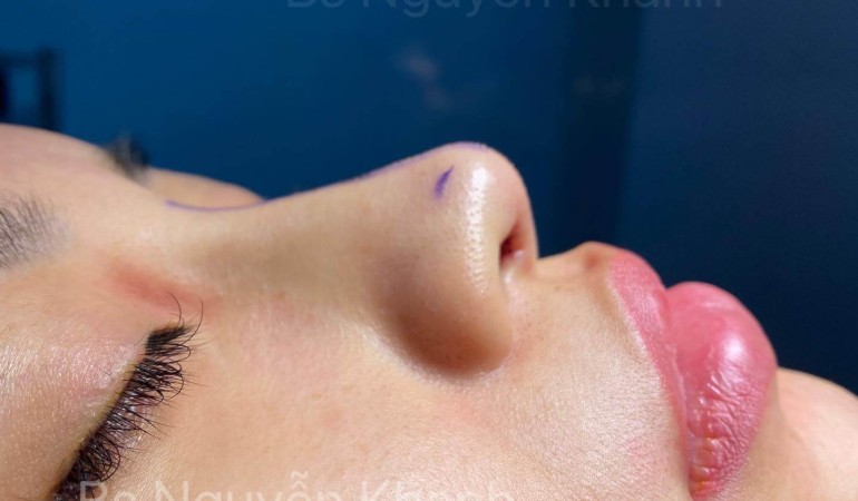 Tổng hợp các dáng mũi lót sụn sau phẫu thuật của ekip BS Nguyễn Khanh