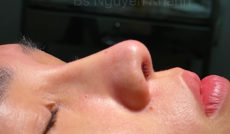 Nhìn ngắn 2 phương pháp mũi cấu trúc và lót sụn sau tết cùng ekip Bs Nguyễn Khanh