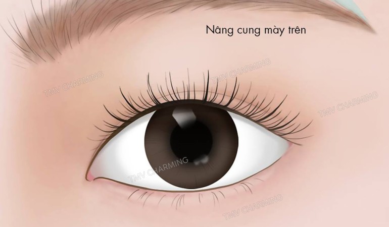 Phân biệt 2 phương pháp nâng cung mày: treo bờ trên và treo bờ dưới