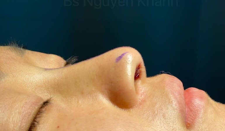 Phương pháp nâng mũi nào thích hợp cho dáng mũi cao nhưng chóp mũi lại thấp