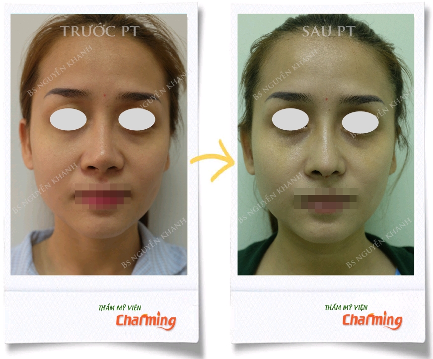 nâng mũi cấu trúc tạo dáng mũi s line phía trước