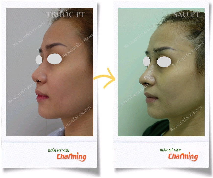 nâng mũi cấu trúc tạo dáng mũi s line nhìn ngang