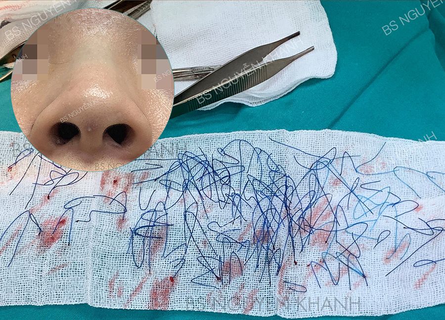 Biến chứng nâng mũi chỉ
