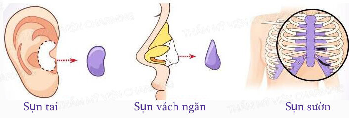 Những phương pháp nâng mũi an toàn