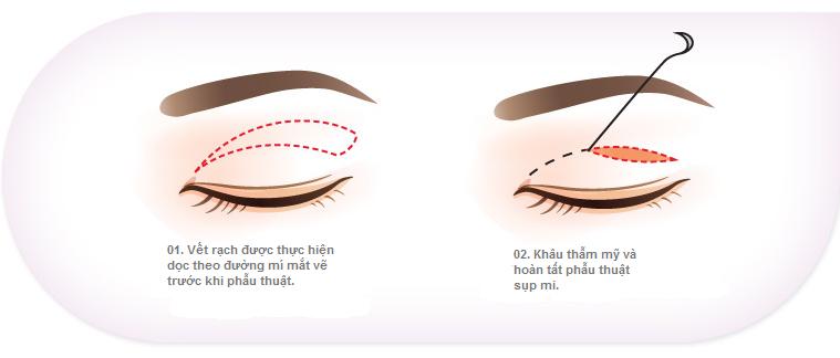 Phẫu thuật sụp mi