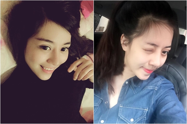 thay đổi sau phẫu thuật