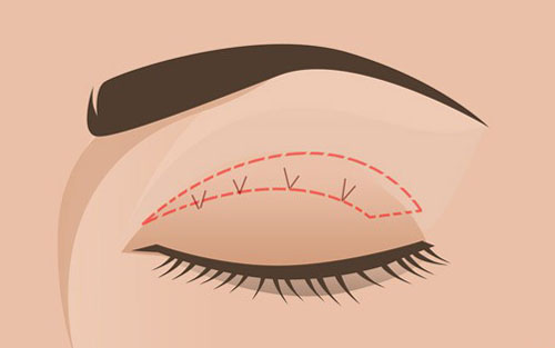 cắt mí mắt