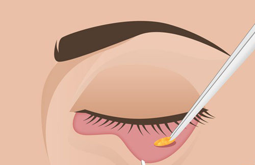 cắt mí mắt